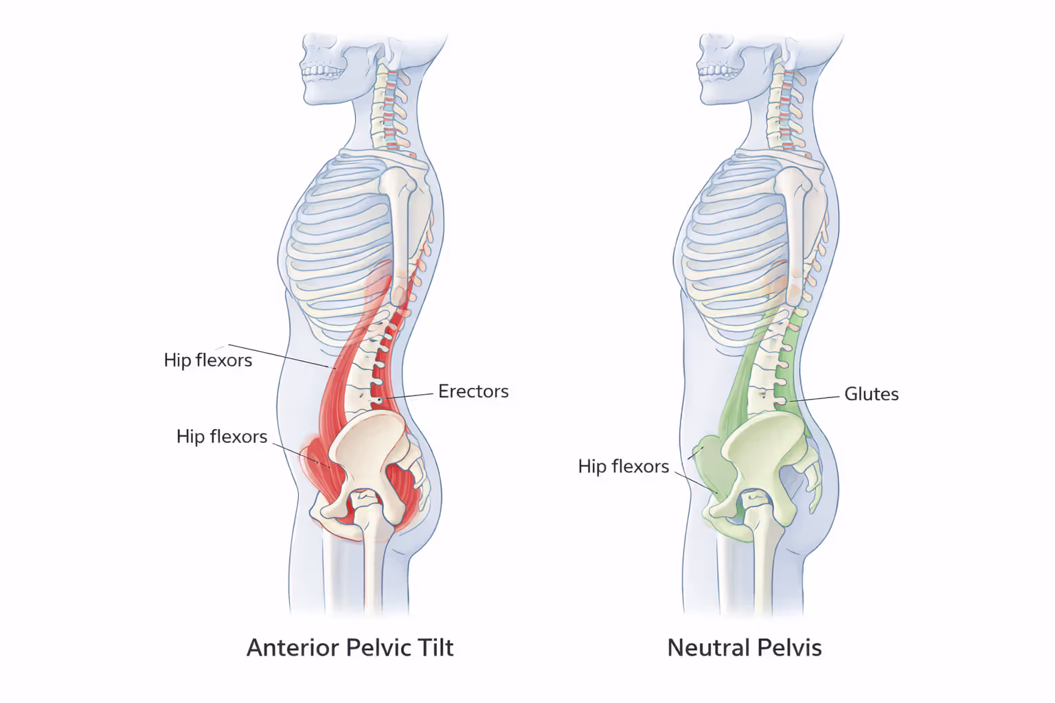 Anterior pelvic tilt vs neutral alignment — muscle imbalance visualized